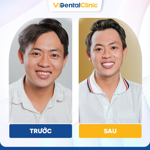 Hình ảnh khách hàng trước và sau khi bọc răng toàn sứ tại ViDental