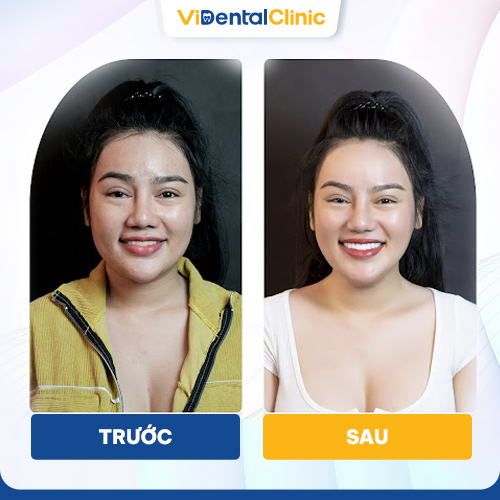 Chị Hoa dán sứ Veneer tại ViDental