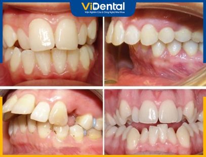 [Giải Đáp Chi Tiết] Những Trường Hợp Không Nên Bọc Răng Sứ